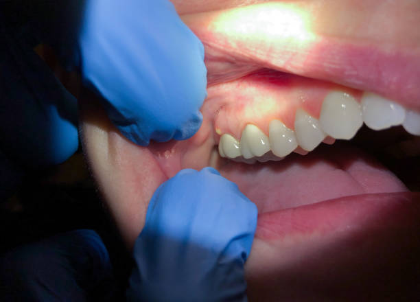 Best Lost Filling or Crown Replacement in Troy, IL